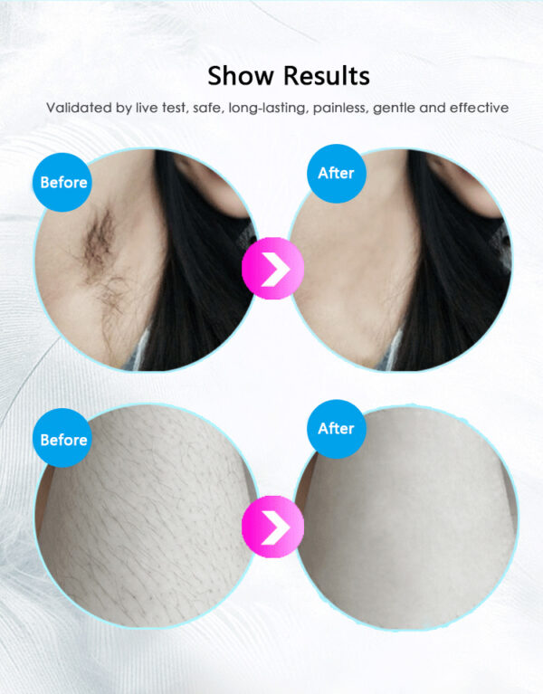 Laser Hair Removal Equipment – Bild 9